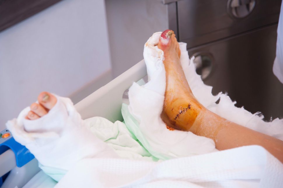 Scar from broken talus bones