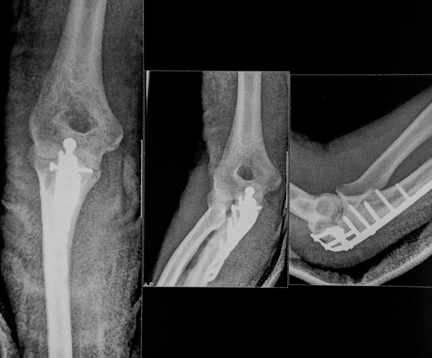 My X Rays from the accident